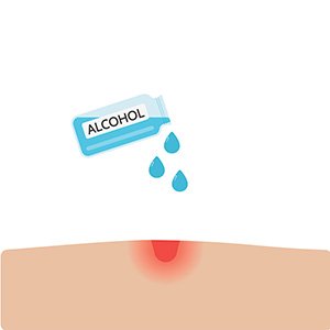 Disinfect the area once you have removed all of the tick.