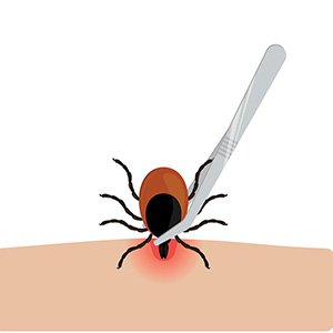 Get the tweezers as close to the head of the tick as possible.